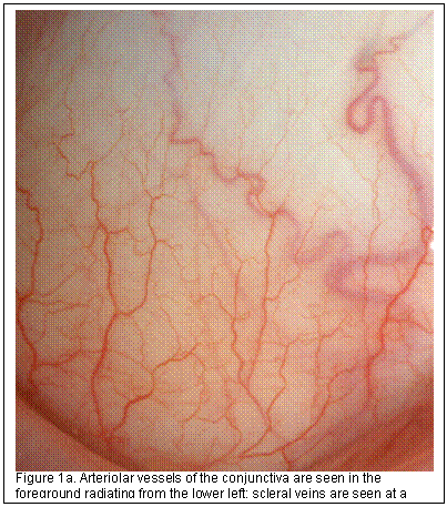 Text Box:  
Figure 1a. Arteriolar vessels of the conjunctiva are seen in the foreground radiating from the lower left; scleral veins are seen at a deeper level with a darker shade of red due to carrying de-oxygenated blood.

