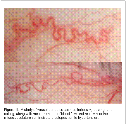 Text Box:  
 
Figure 1b. A study of vessel attributes such as tortuosity, looping, and coiling, along with measurements of blood flow and reactivity of the microvasculature can indicate predisposition to hypertension.